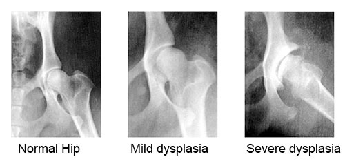 x ray dysplasia